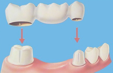 dental-bridges