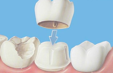 dental-crowns