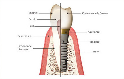 dental-implants