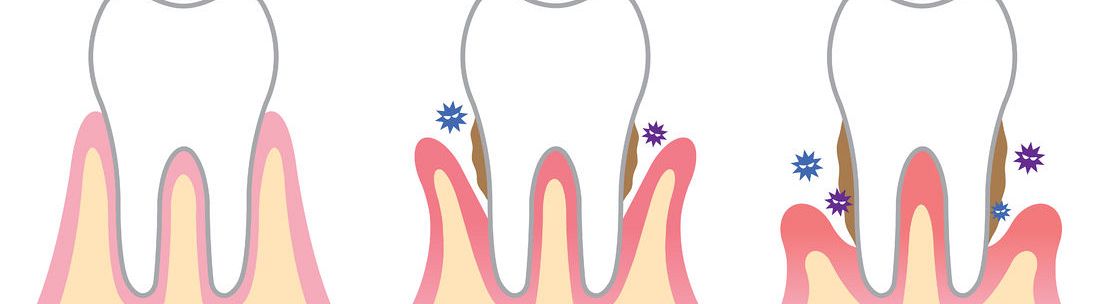 What is gingivitis? 