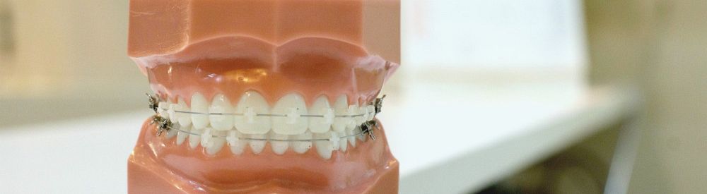 How do I know if I need braces?