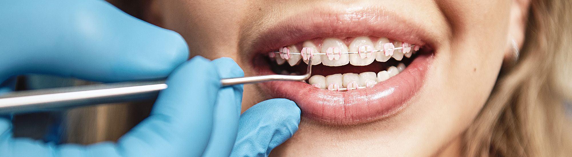Caring for Orthodontic Braces from a Hygienist Mom’s perspective
